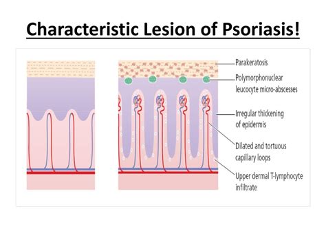 Ppt Psoriasis Powerpoint Presentation Free Download Id485860