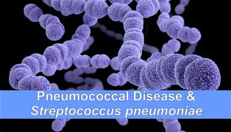 Virulence Factors Pathogenesis And Clinical Manifestations Of Streptococcus Pneumoniae