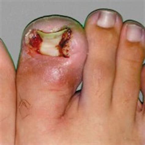 Webmd veterinary reference from the aspca. INGROWING TOENAIL SURGERY Leeds | Yorkshire Foot Hospital