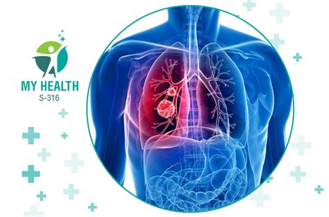Lung Cancer Types Causes Symptoms And Treatment