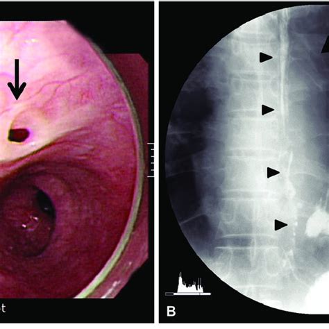 A Initial Upper Gastrointestinal Endoscopy Image Showing An Opening Download Scientific