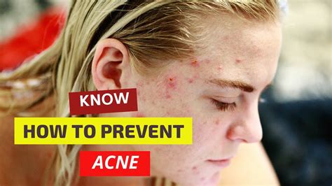 How To Prevent Acne YouTube