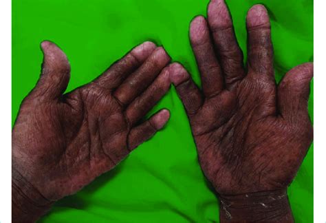 Showing Localised Hyperpigmentation In Palms Of Hand Download