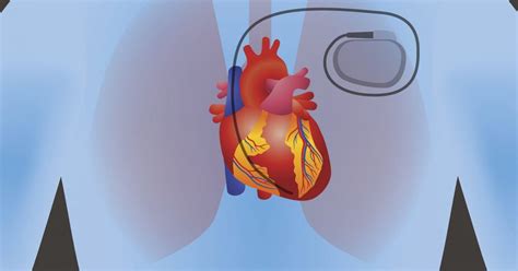 Living With A Pacemaker Facty Health