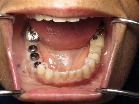 Ramsey Amin Dds Case Review Replace Loose Long Bridge With Dental