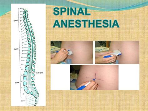 Chapter 8 Spinal Anaesthesia Ppt