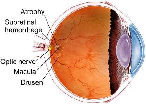 Age Related Macular Degeneration The American Society Of Retina