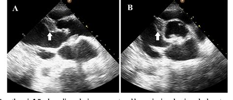 Figure 2 From Aortic Root Abscess Presenting As Alternating Bundle
