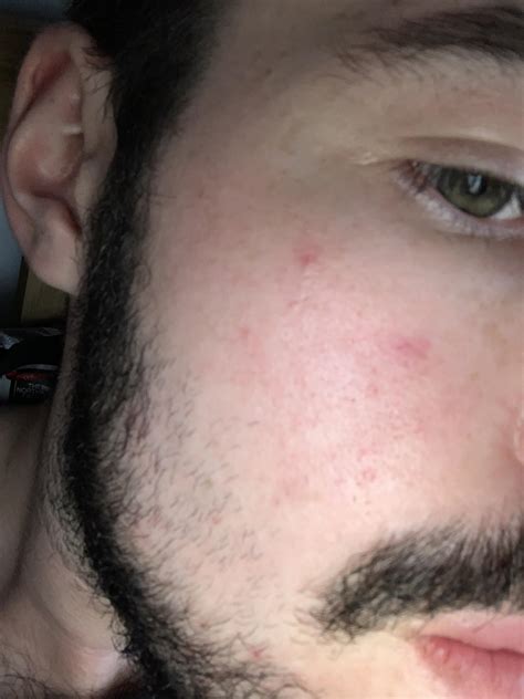 Skin Concerns For Over A Year Ive Had These Red Blotches On My Face