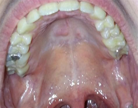 Photos Of Cancer On The Roof Of The Mouth