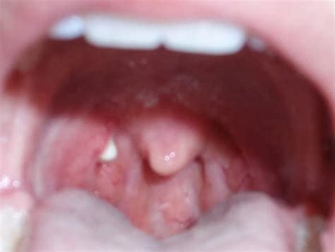 Post Nasal Drip Sore Throat And Cough Acute Laryngitis Corticosteroids