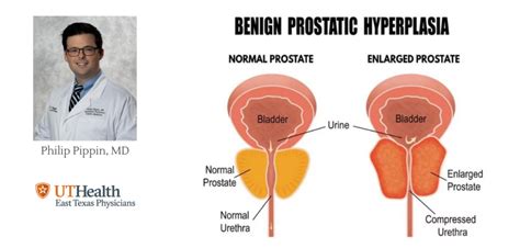 Mens Health Month Benign Prostatic Hyperplasia Ut Health East Texas