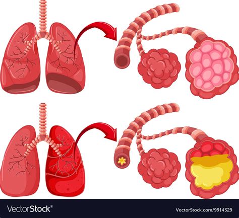 Human Lungs With Pneumonia Royalty Free Vector Image