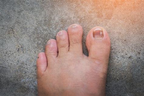 Are those dark spots fungi growths? Toenail Discoloration | Causes, Prevention & Treatments