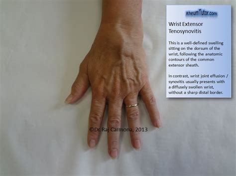 Tenosynovitis Hand