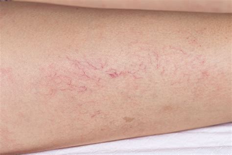 Laser Vein Treatments Spider Veins Broken Capillaries And Angiomas