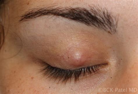 How Do You Treat A Chalazion And What Are Chalazions Patel Plastic Surgery Salt Lake City And