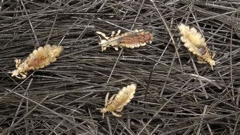 Head Lice Resistant To Over The Counter Treatments In 25 States Abc7
