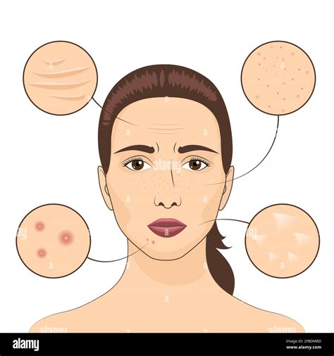 Woman Skin Problem Vector Illustration Female Face With Skins