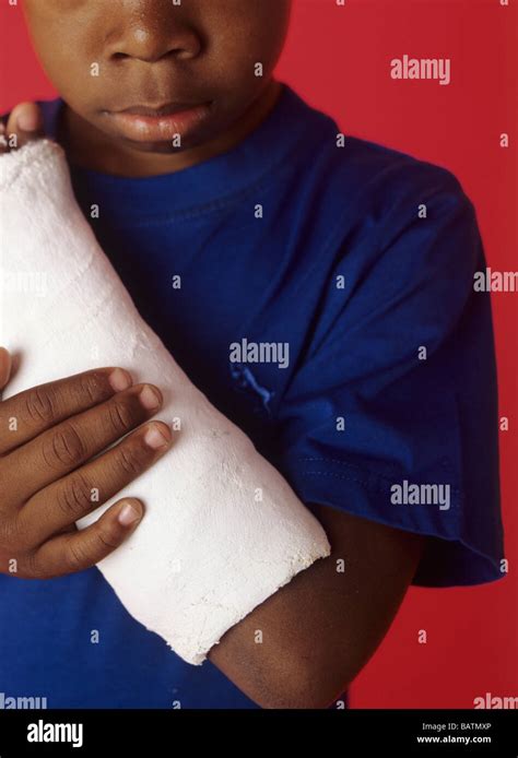 Broken Arm 6 Year Old Boy With His Broken Arm In A Plaster Cast The