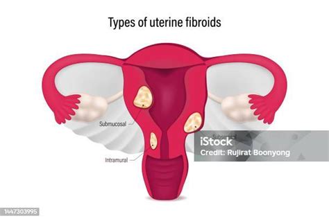 Types Of Uterine Fibroids Submucosal Subserosal And Intramural Fibroids