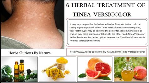 6 Herbal Treatment Of Tinea Versicolor Herbs Solutions By Nature Blog