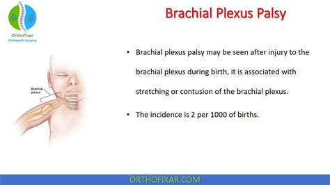 Brachial Plexus Palsy • Easy Explained Orthofixar 2022 Brachial