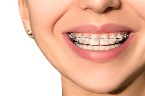Self Ligating Braces In Scarsdale Ny Blais Orthodontics