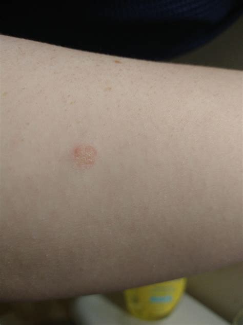 What Is This Dry Patch On My Arm I Have One On The Back Of My Calf