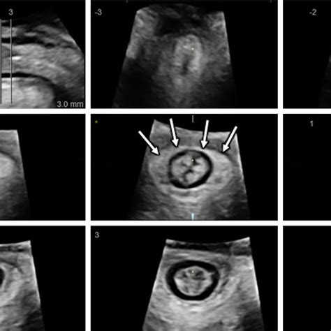 Technique For Transperineal Ultrasound Scan For Fetal Head Descent And