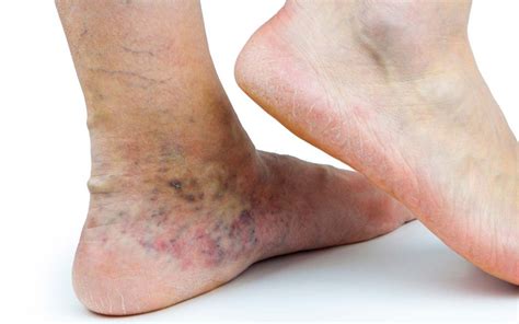 Trombose in een oppervlakkige ader wordt aderontsteking genoemd. Venous Dermatitis: Untreated Varicose Vein Complications
