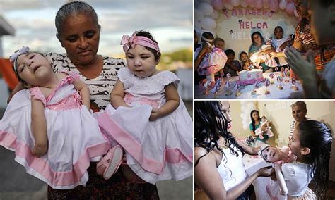 Brazilian Twins With Zika Celebrate Their First Birthday Daily Mail Online