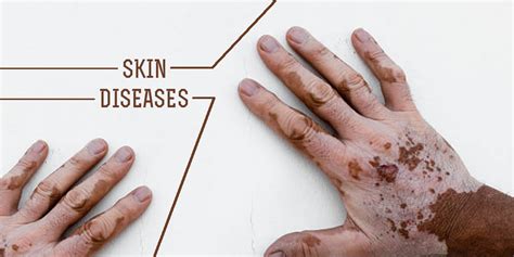Types Of Skin Disease Gomedii Healthcare Blog