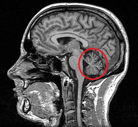 Discover more about multiple sclerosis. Cerebelo: Mucho más que coordinación motora - Guía completa