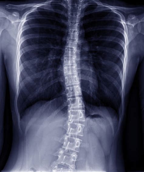 Scoliosis Meaning Symptoms And Treatment Alqudrahmc