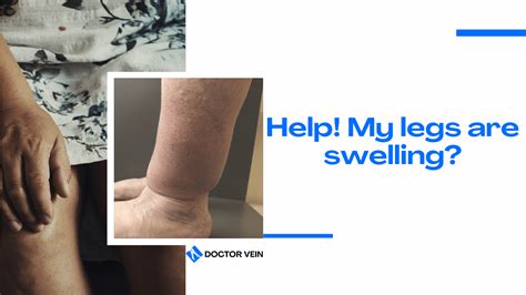 Help Why Are My Legs Swelling Doctor Vein