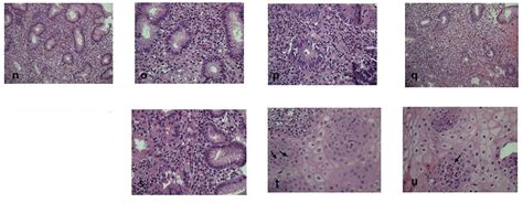 Frontiers Case Report Dupilumab Treatment Improved Type 2 Disorders