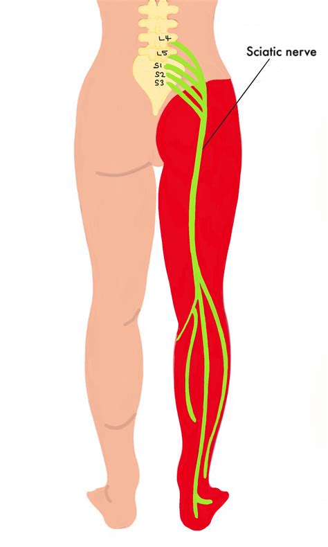 Sciatica And Radicular Leg Pain Spines Dorset