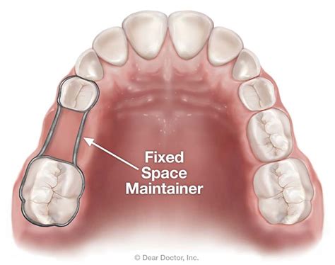 Space Maintainers Dentistry And Orthodontics