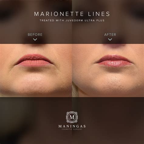 Results From 1 Syringe Of Juvederm Ultra Plus To Treat Marionette Lines