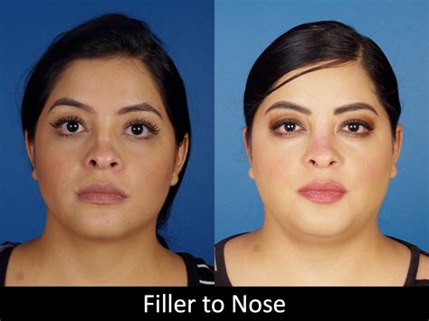 Botox And Fillers Before And Afters Raval Facial Aesthetics Denver