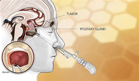 The resilient pituitary gland: What happens when the ...