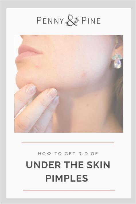 How To Get Rid Of Under The Skin Pimples Painful Pimple Under Skin