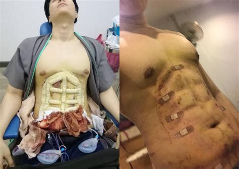 Instant Six Packs Now Possible At This Plastic Surgery