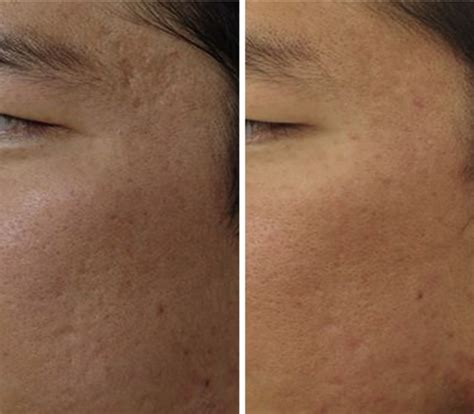 Acne Scars Can Now Be Improved Nicely With Modern Lasers And Other Devices