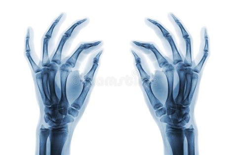 Film X Ray Both Hand Ap Show Normal Human Hands On White Background
