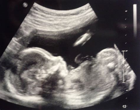Pregnancy Books Landmark 20 Weeks Pregnant Baby Girl Ultrasound