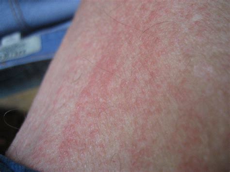 I Noticed A Red Rash Streaking In Inner Tighs And Around