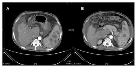 Splenic Abscess In Immunocompetent Patients Managed Primarily Without