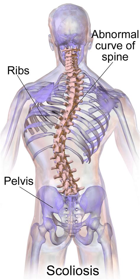 Scoliosis Sma Curvature Of The Spine Causes And Treatment